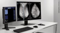 Image: Two computer screens on a desk; the right screen shows a mammography image; Copyright: Siemens Healthineers 